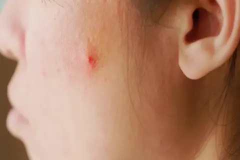 ニキビのオンラインで診察について