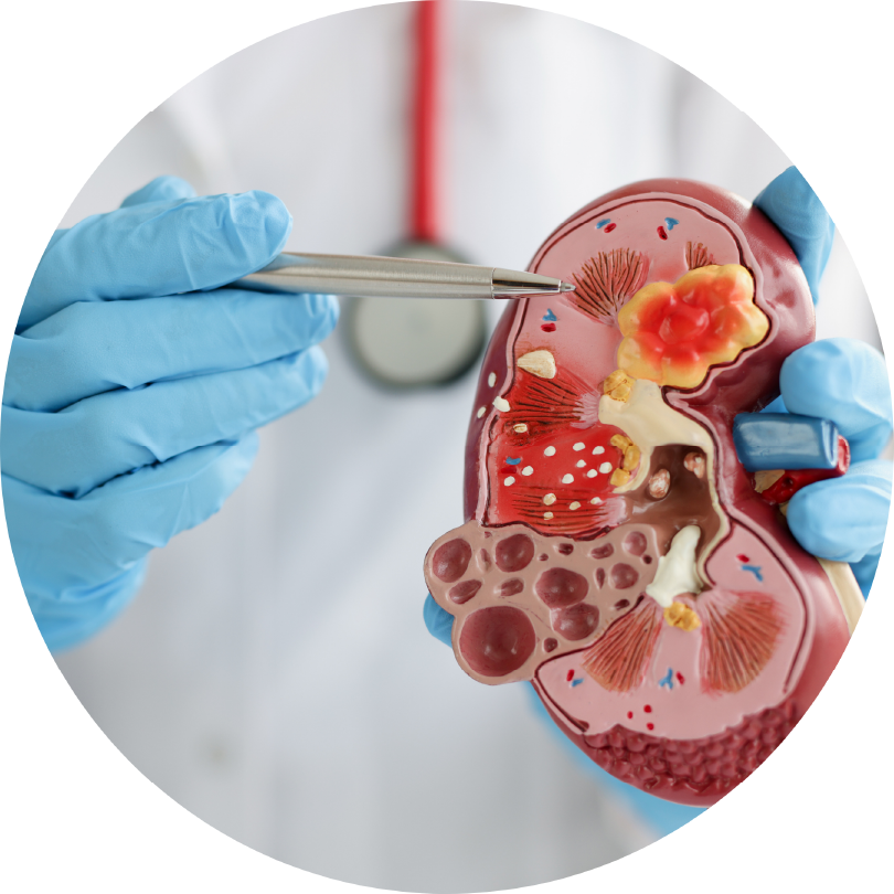 糖尿病性腎症の画像